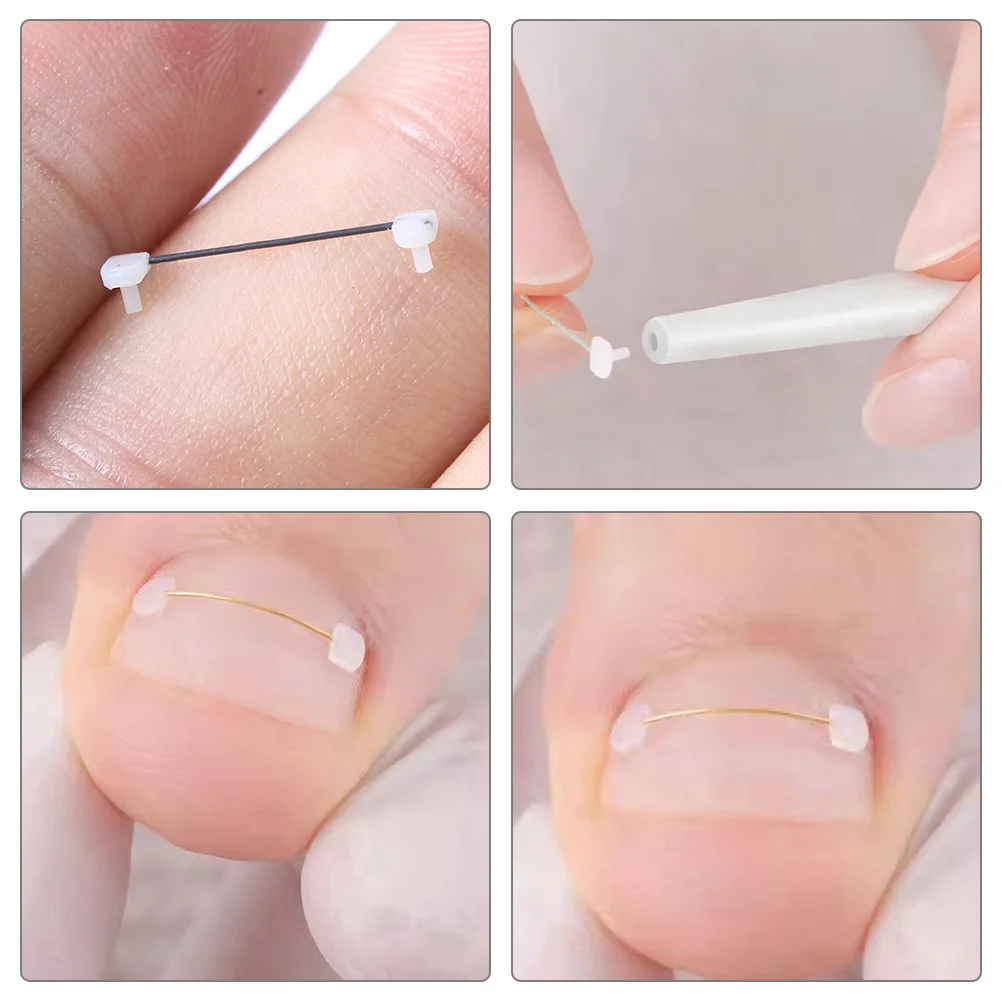 

6Pcs Ingrown Toenail Correction Wire Titanium Alloy Durable Elastic Toenail Straightener Nail Pain Relief Portable for Travel