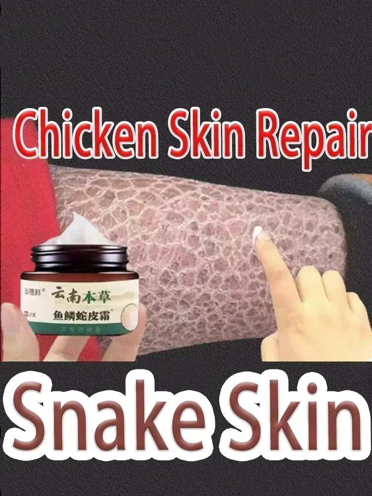 

02SALE Chicken Skin Repair Cream Curing Keratosis Follicle Pilaris Body Dark Spot Remove Thick Pores Moisturizing Smooth Essen