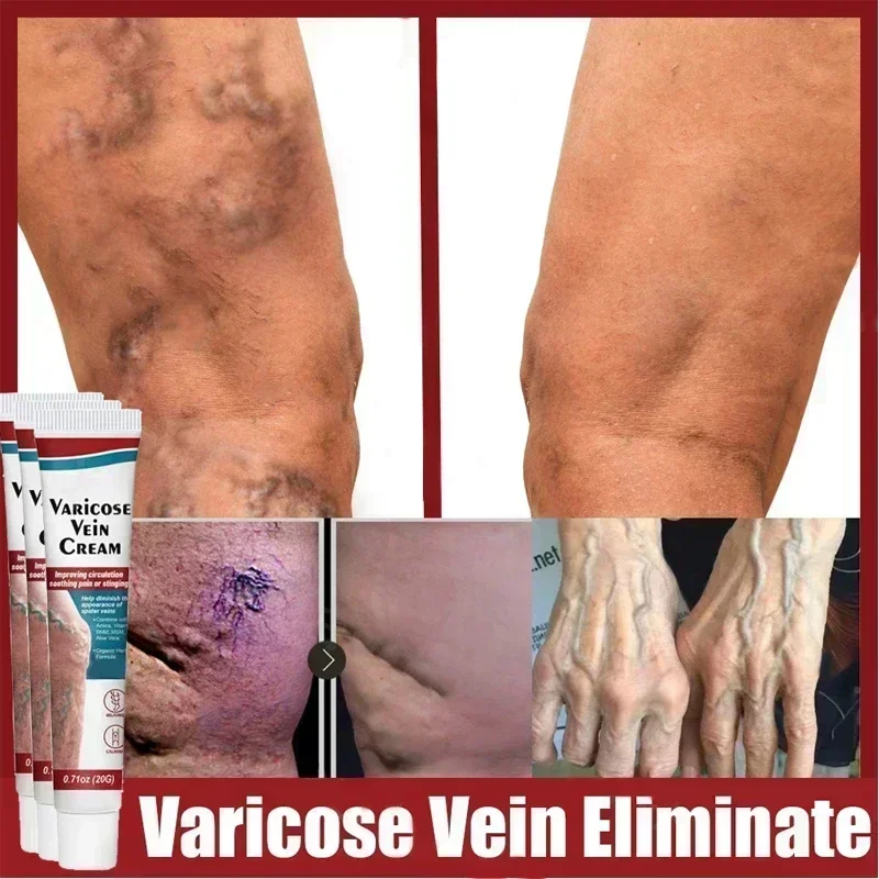 Crema de eliminación de venas varicosas, tratamiento efectivo para Vasculitis, gusano de tierra, Araña, reparación del dolor de piernas, pomada para aliviar la flebitis de yeso