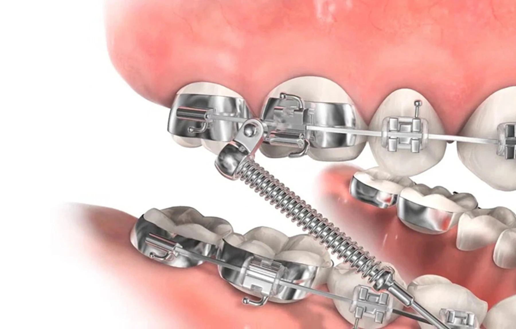 Orthodontic Class II Corrector Fatigue Resistant Device Push Rod 22-38mm Forsus