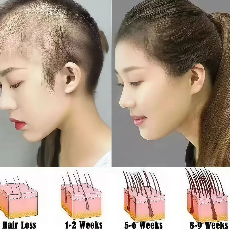 

Medical Grade Red Light Therapy Cap 96 Laser Beads Low Frequency for Hair Regrowth & Oily Scalp Treatment Adjustable