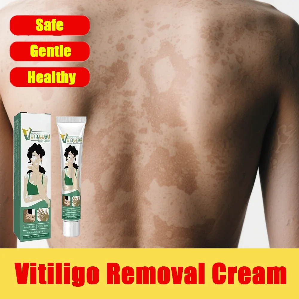 

Vitiligo Removal White Spot Care Cream Skincare cream vitiligo skin Sweat spot Reduce white spots Skin care