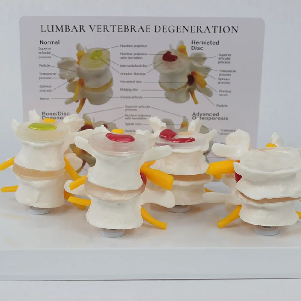 4-stage Pathological Human Lumbar Spine Anatomy Model Medical  Science Teaching Resources model With back card