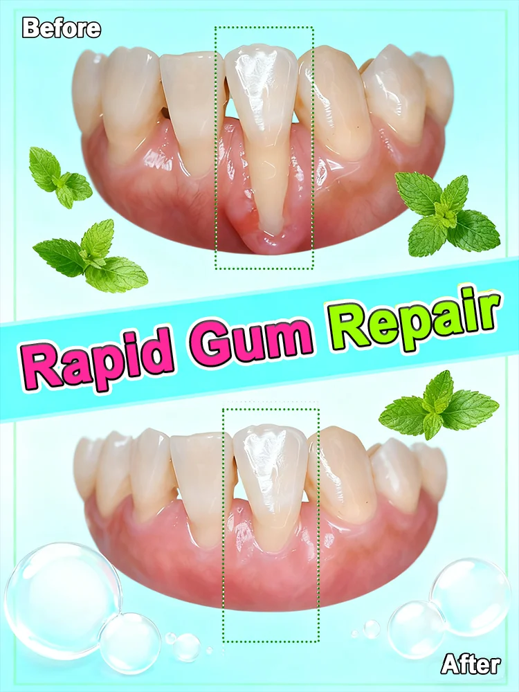 

Eᴀsɪʟʏ ʀᴇɢᴇɴᴇʀᴀᴛᴇ ɢᴜᴍs ᴀɴᴅ ᴄᴏᴠᴇʀ ᴛᴇᴇᴛʜ ɪɴ 7 ᴅᴀʏs