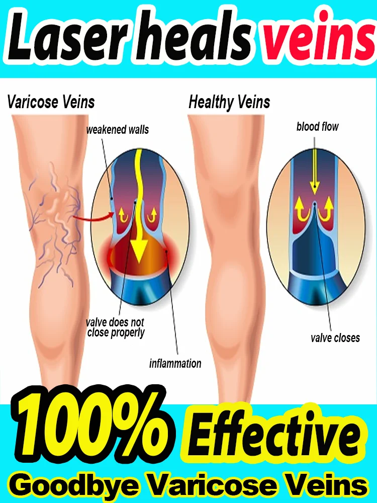 El láser azul cura las venas de las piernas