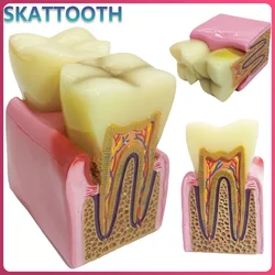 8 Times Dental Model Caries Disease Periodontitis Case Analysis Teeth Model for Dental Demonstration Model Dentist Teaching
