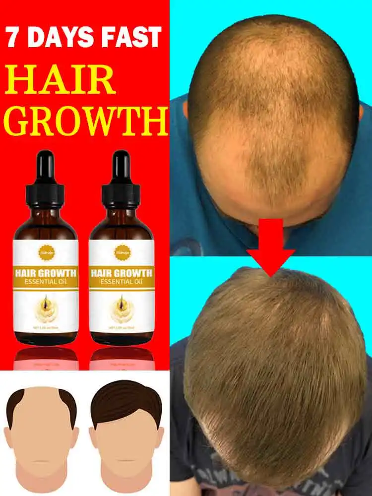 

Fast Hair Regrowth Essence, Repair Dryness, Increase Hair Volume, Nourish Damaged Hair, Scalp Treatment Oil