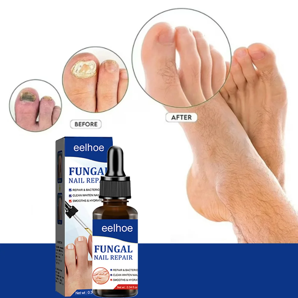 Verwijder nagel schimmel serum voetverzorging