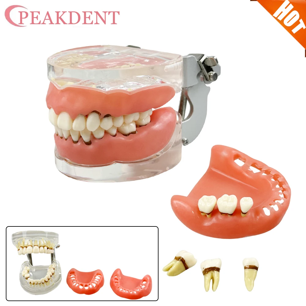 

Модель зубов, обучающая модель стоматолога, демонстрационная заболевания пародонта, патологическая для образования пациентов, демонстрация M4017