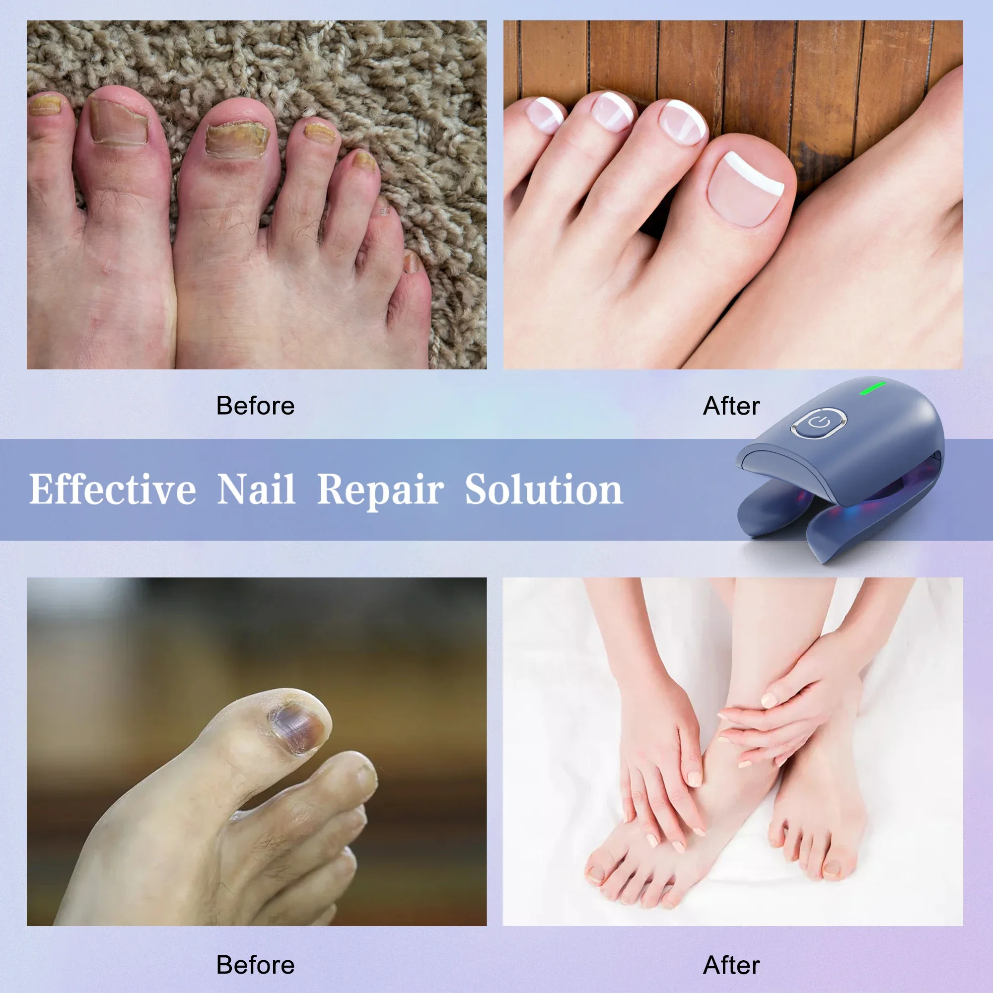 Nail fungus laser therapy device, USB charging, onychomycosis treatment, treatment machine, neutral foot care tool