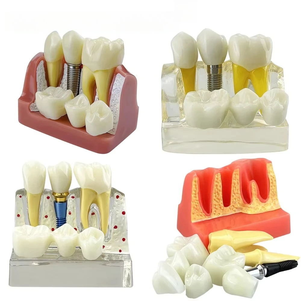4 Times Dental Implant Demonstration Model Teeth Implant Analysis Crown Bridge Removable Model For Dentist Student Teach Study