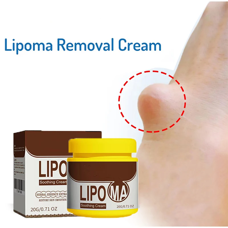 20g Anti-swelling Lipoma Removal Cream Organic Lymphatic Drainage Detox Effective Painless Treatment Breast Lymph Nodes Cream