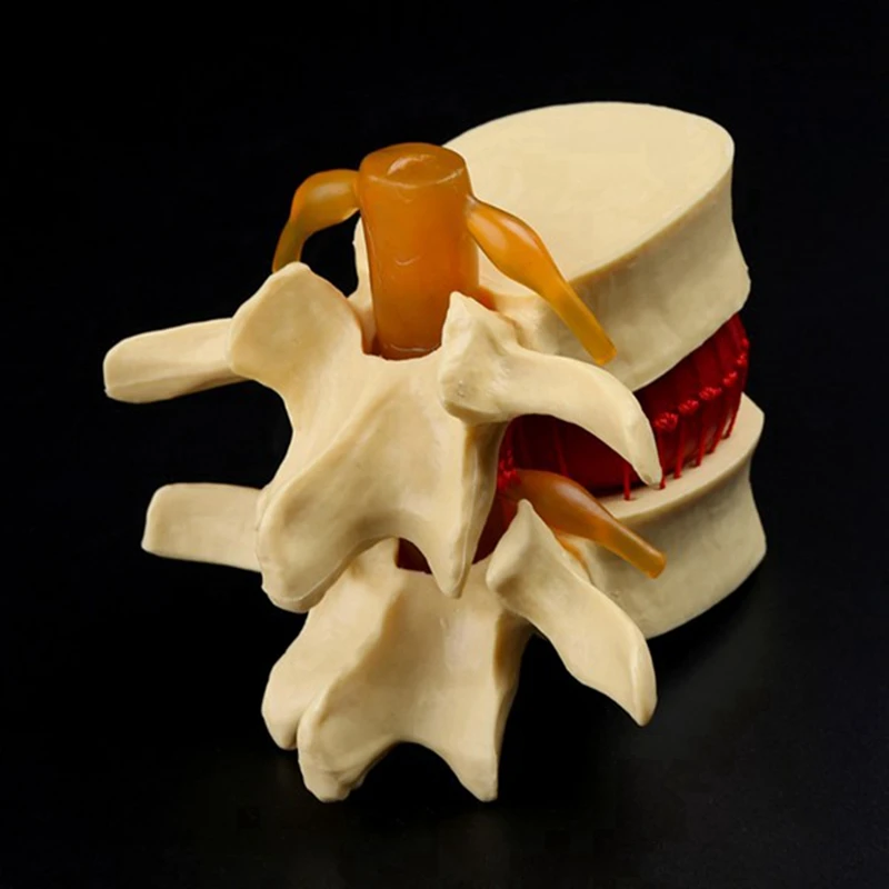 2X Lumbar Vertebrae Model Anatomical Spine Lumbar Disc Herniation Anatomy Teaching Tool Lumbar Vertebrae Model