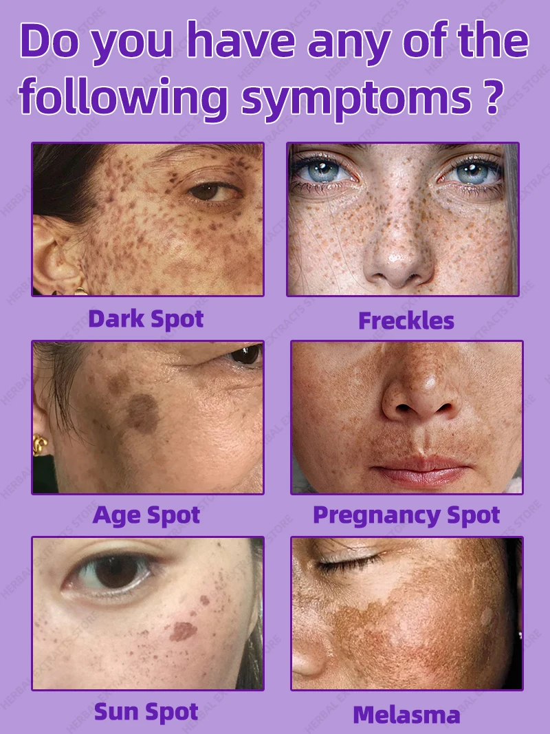 Freckles Melasma Sun Age Dark Spot