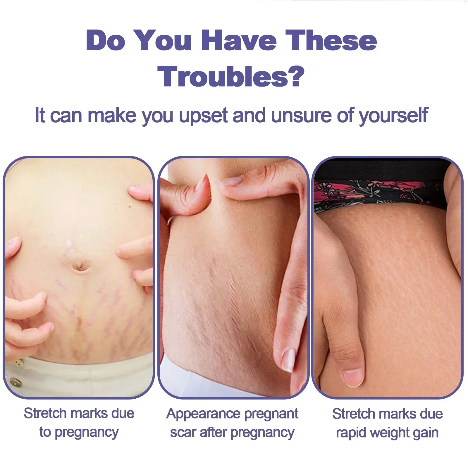 Pregnancy Repair Stretch Mark Removal Acne Scar Maternity Stretch Marks Remove Fat Striae Scars Treatment skin Care