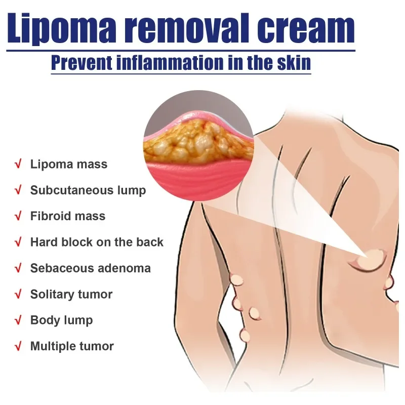 Pomada de eliminación de Lipoma, tratamiento de celulitis, eliminador de Fibroma, bultos subcutáneos, múltiples Lipomas, masa de grasa, crema de medicamentos, 20G