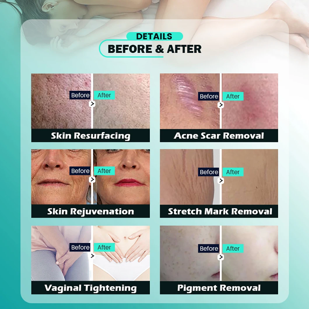 2024 Fractional CO2 Laser system Scar Stretch Marks Removal Machine Wrinkle powerful laser Treatment Skin Resurfacing Device