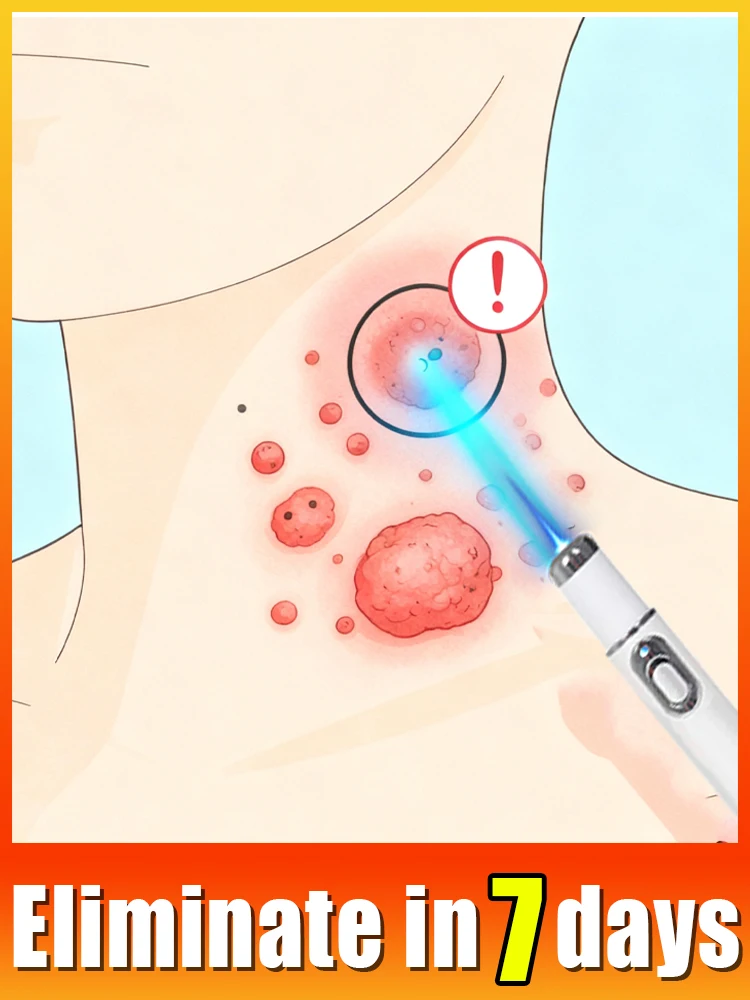 

Suitable for all types of warts, both men and women.