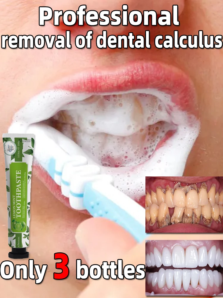 Dentífrico removedor de cálculo dental, remover os dentes amarelos, mau hálito, placa de limpeza, mancha dentária, clareamento, prevenção da periodontite