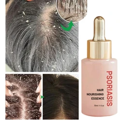 30ml Hair Treatment Remove Dandruff And Relieve Essence Prevent Loss Serum Oil Control Smooth Nourish Repair Hair Scalp Care