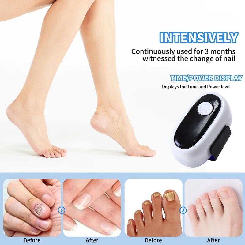 NEW_ جهاز العلاج بالليزر لفطريات الأظافر للعلاج أ