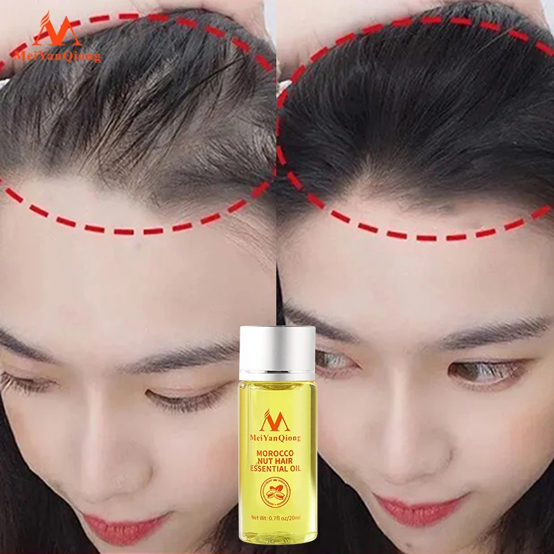 Fast Hair Growth Essence Anti Hair Loss Products Essential Oil Liquid Treatment Preventing Hair Loss Hair Care powerful tonic