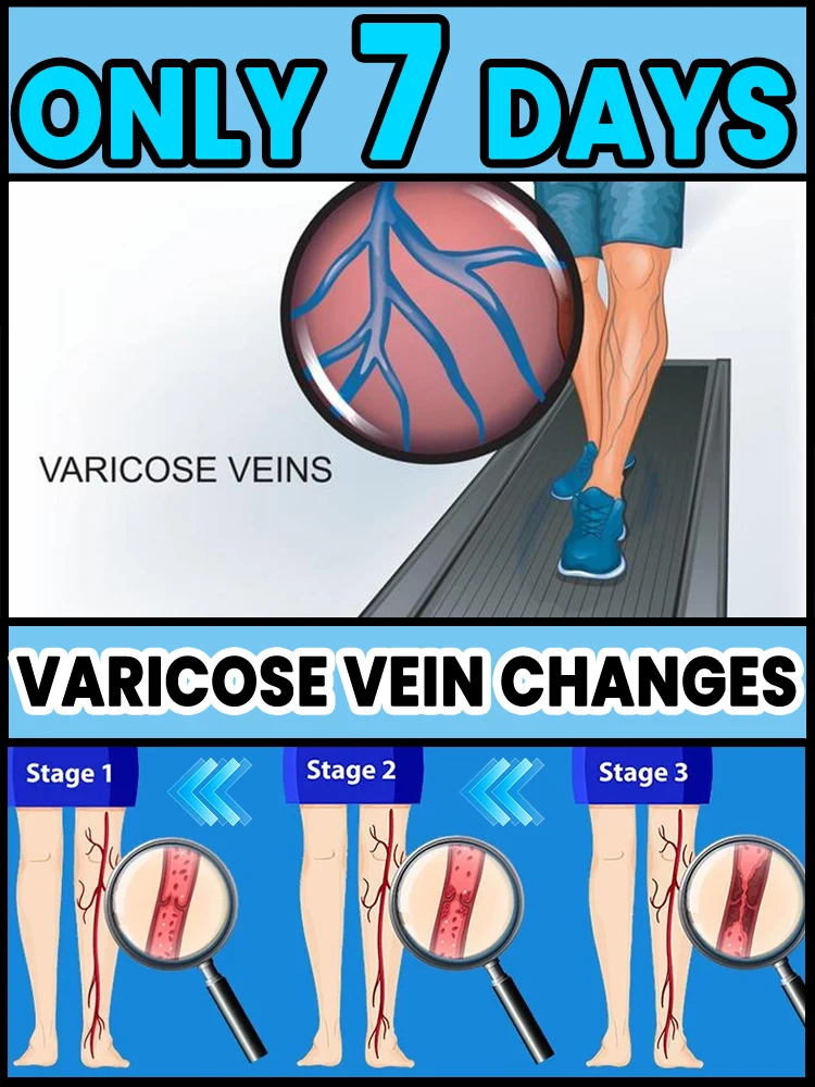 2e mini blauwlichtlaserpen, spataderenbehandeling, bescherming van uw benen.