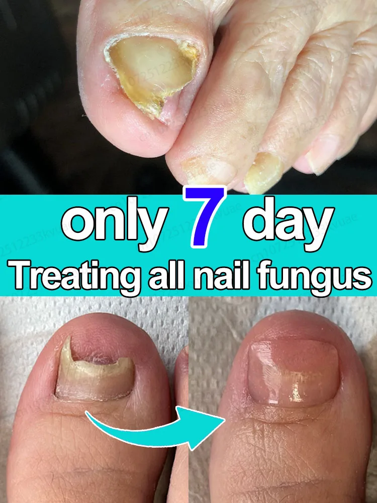 

ᴺᵃⁱˡ ᶠᵘⁿᵍᵘˢ ᵗʳᵉᵃᵗᵐᵉⁿᵗ ᵉˢˢᵉⁿᵗⁱᵃˡ ᵒⁱˡ⸴ ʳᵉᵖᵃⁱʳ ᵒⁿʸᶜʰᵒᵐʸᶜᵒˢⁱˢ ⁱⁿ ⁷ ᵈᵃʸˢ