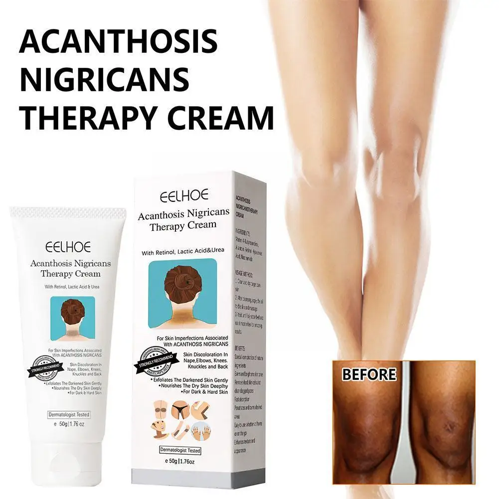 Acanthosis Nigricans Therapy Cream Cream For Underarm Arm Knee Joint Black Moisturizing And Whitening Body Care Crea O3I6