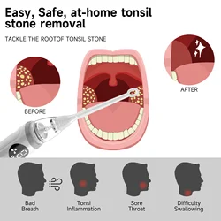 New Home Oral Care Tool Set Tonsil Electric Suction Stone Remover Stone Removal Tool Suction Tonsil Stone Sucker