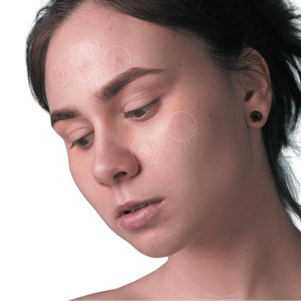 36 parches hidrocoloides para el acné: absorben Pus & Oil, reducen el enrojecimiento, ajuste invisible para uso durante todo el día.