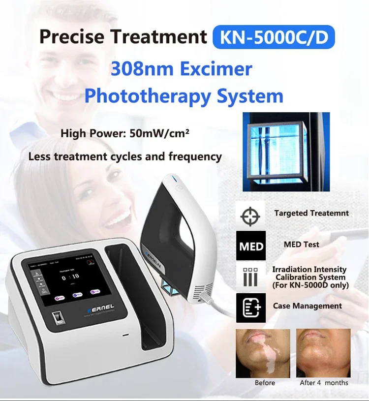 Lampade Uvb ultimo Kernel Kn-5000c Eximer Laser 308nm lampada vitiligine 308nm luce Uvb per psoriasi vitiligine Cure