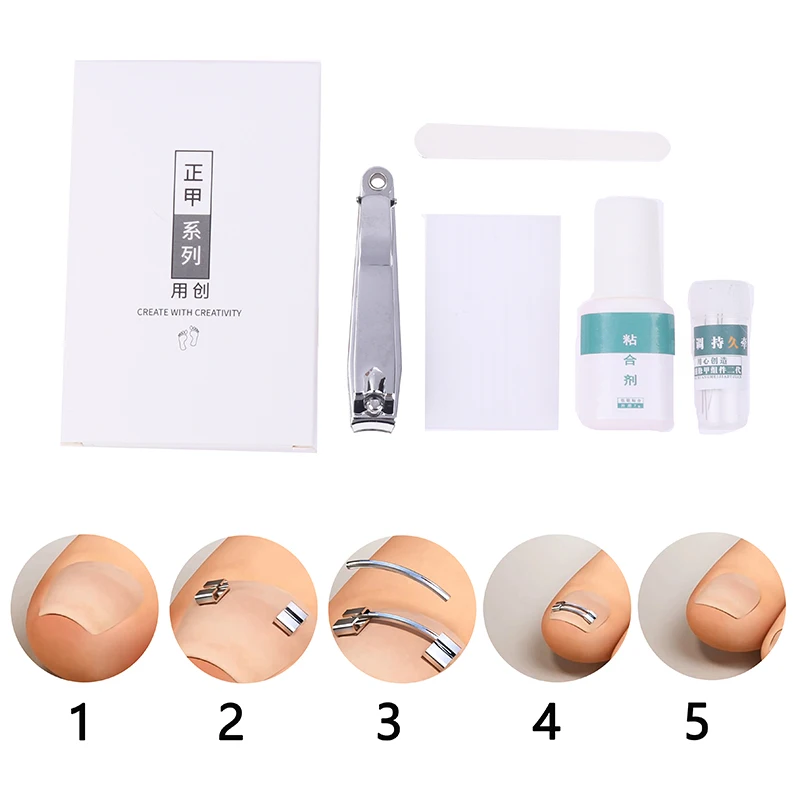 Ingegroeide Teennagel Correctietools Professionele Behandeling Herstellen Insluiting Teennagel Apparaat Pedicure Radiologie Rechttrekken Teen Gereedschap