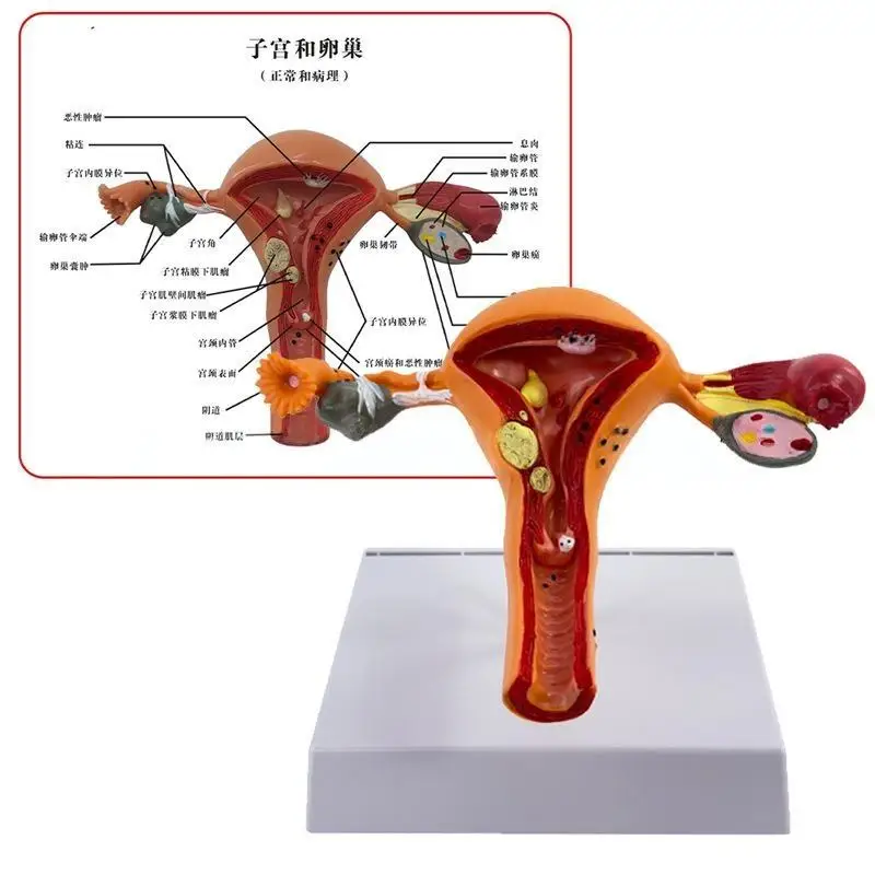 Medical Science Normal/Pathological Uterus Ovary Anatomical Model Anatomy Cross Section Medical teaching supplies