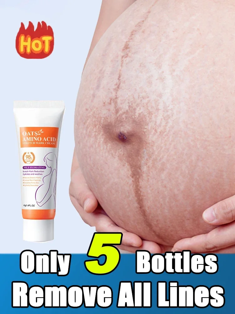 Gentle Skin Care Improves Elasticity Effective After Pregnancy Stretch Marks Removal Powerful Maternity Cream Nourishes Skin