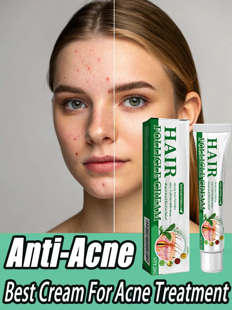 3RD crema antiacné eficaz elimina los nódulos de la piel Pustules Cysts Papulos puntos negros hombres y mujeres acné cuidado de la piel crema de esencia