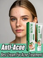 3RD crema antiacné eficaz elimina los nódulos de la piel Pustules Cysts Papulos puntos negros hombres y mujeres acné cuidado de la piel crema de esencia