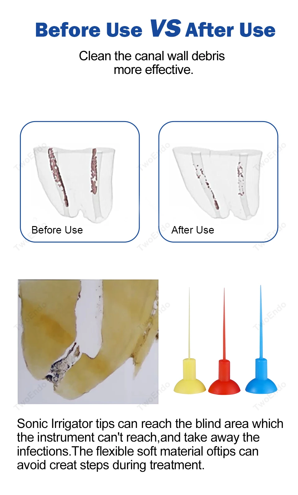 20 Stück Dental Endo Sonic Irrigator Tipps für Wurzelkanalbehandlung Zahnarztmaterialien – Detail 5