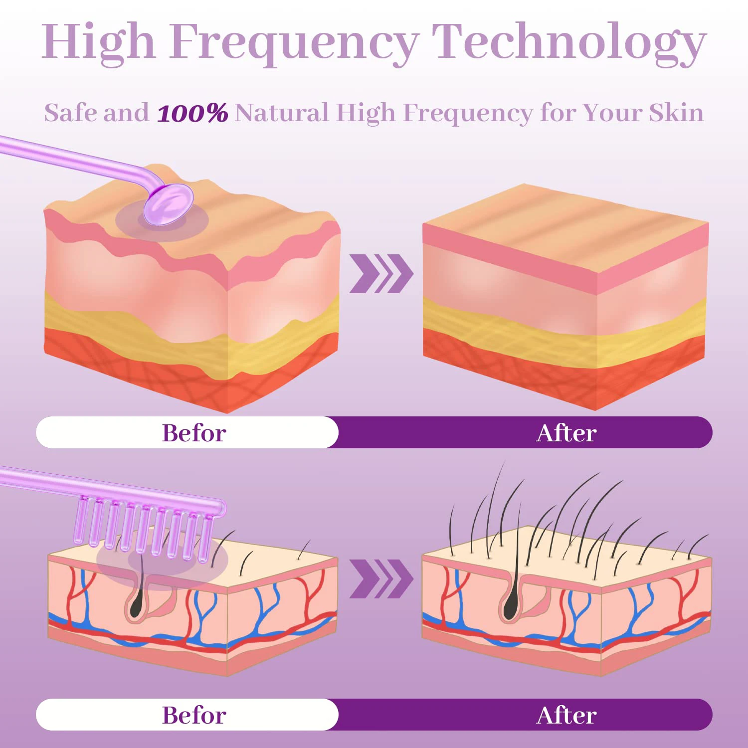 Varita de terapia Facial portátil de alta frecuencia, herramientas eléctricas de mano para la belleza de la piel, máquina de tratamiento del acné, cuidado de la piel LESEN EE. UU.