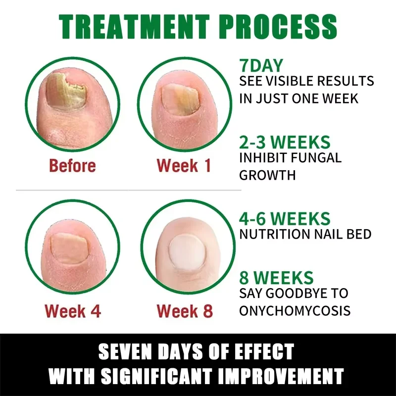 7 dias tratamento de fungos nas unhas óleo essencial pé dedo do pé remoção de fungos nas unhas soro reparos onicomicosi produtos de cuidados anti infecção