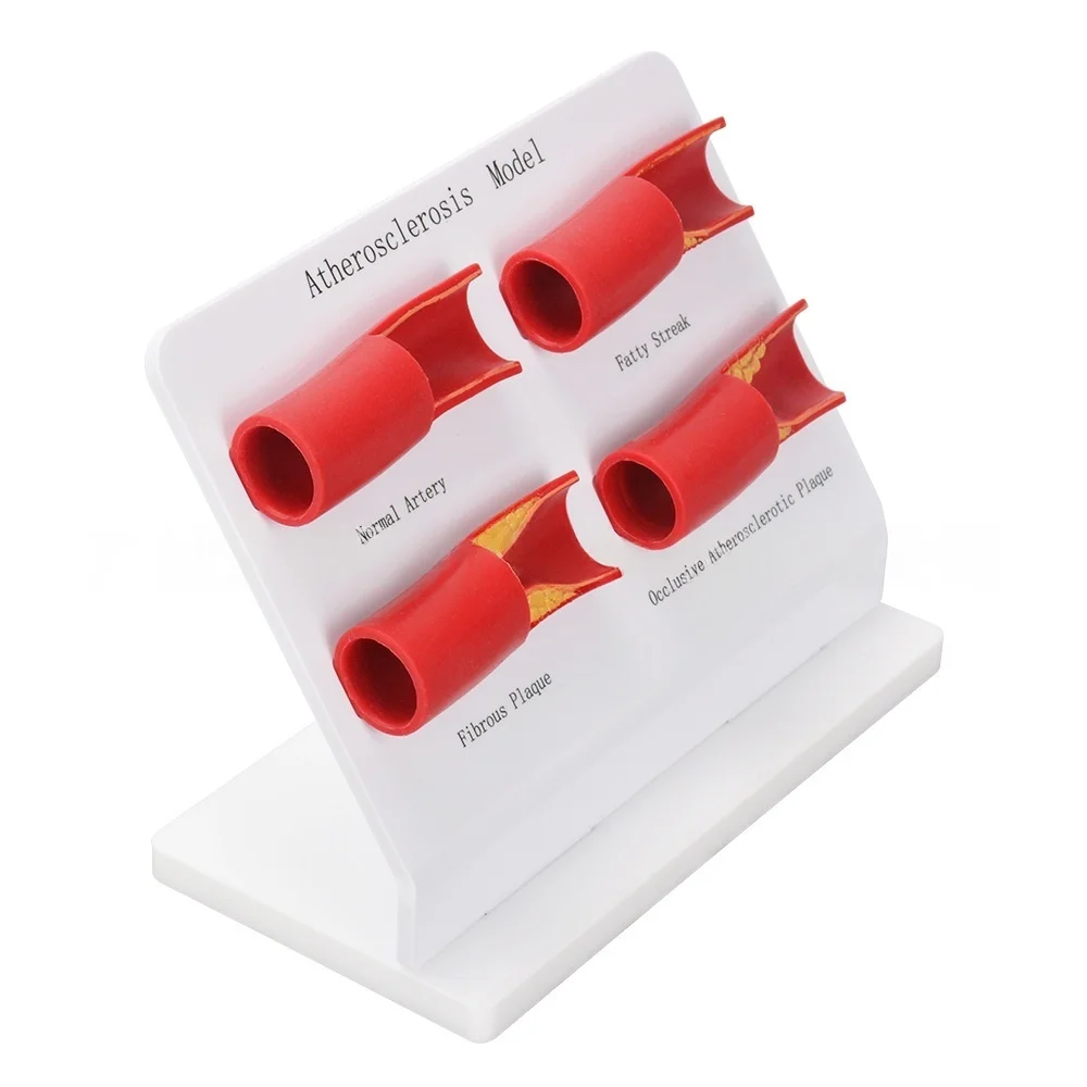 Teaching Demonstration Model, Arterial Atherosclerosis Model, Vascular Model, Vascular Sclerosis Comparison Model