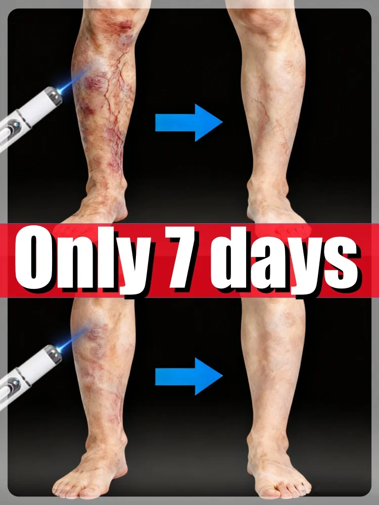 

ʟᴀsᴇʀ ᴛʀᴇᴀᴛᴍᴇɴᴛ ᴛᴏ ғᴀᴅᴇ ᴠᴀʀɪᴄᴏsᴇ ᴠᴇɪɴs ᴀɴᴅ ᴘʀᴏᴍᴏᴛᴇ ᴄɪʀᴄᴜʟᴀᴛɪᴏɴ ɪɴ 7 ᴅᴀʏs