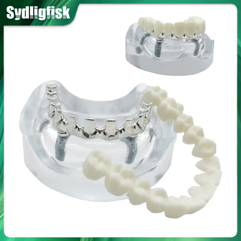 

Dental Model Implant Restoration Model Maxillary Removable Overdenture Model With 4 Implants Dentist Students Education Model