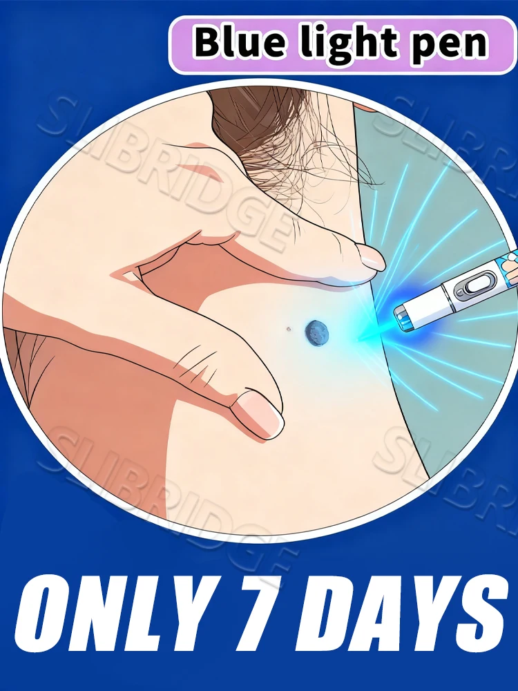 

Wart care tools 2nd Upgraded Version,blue light pen unisex,2025 hot sale
