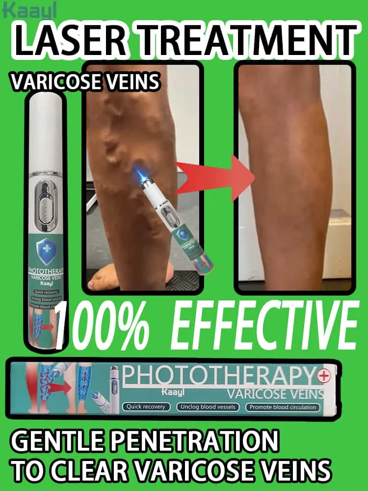 

Laser Vein