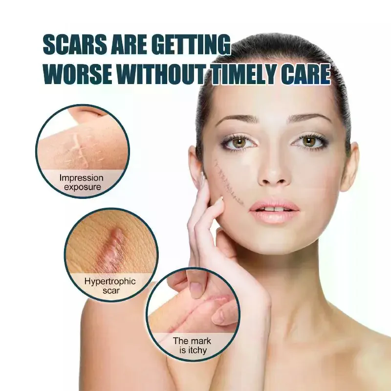 /JCS/Silicone Gel Scar Sheet Patch Treatment Removal Tape Cover Burn Trauma Repair  Ear Scar Section Beauty Skin 1 Roll