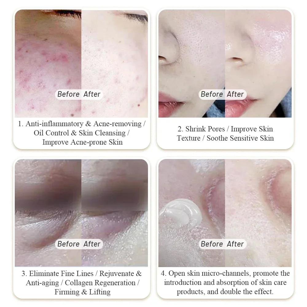 

2023 Leaflife Face lifting Skin Rejuvenation Cold Plasma Fibroblast Facial skin tightening device for face and neck2025