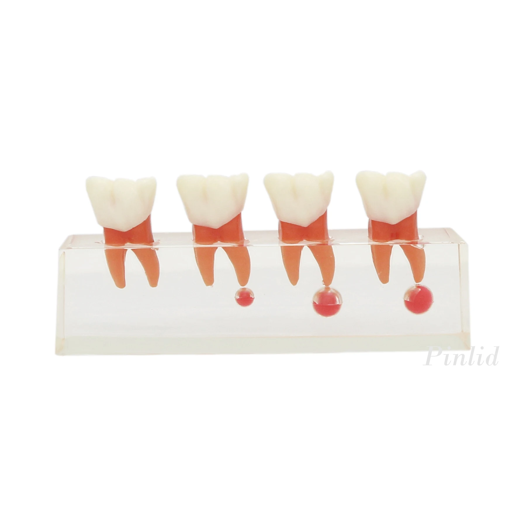 Dental Treatment Model 4-Stage Endodontic  for Study Teaching Teeth Model 4018 Root Canal Demonstration Teach Tooth Model Clear