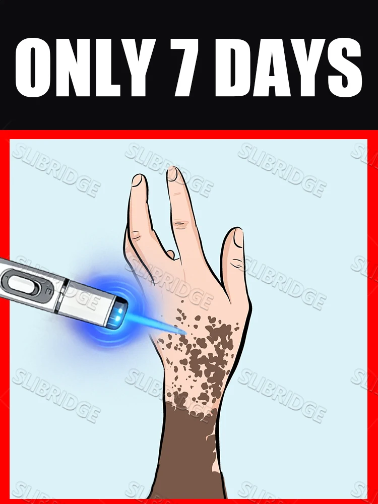 

2025 Модернизированная ручка с синим светом решает витилиго, инструменты для ухода за ногами, унисекс, горячая распродажа