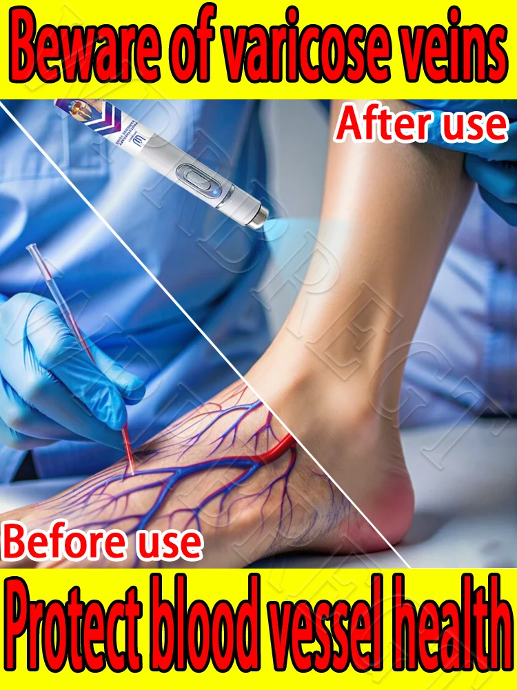 

Laser breakthrough therapy to cure varicose veins‼